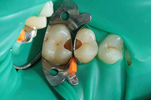 Пациент обратился с жалобами на болевые ощущения в области 2.5 2.6 зубов при приеме пищи.