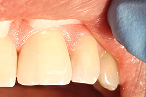 Жалобы на эстетический дефект во фронтальной области зубов 1.1, 2.1