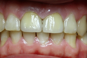 Пациент обратился с жалобами на эстетический дефект зубов 1.1 2.1