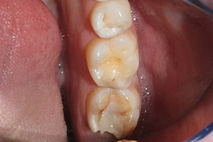 Пациент обратился с жалобами на разрушение пломбы на 4.7 зубе