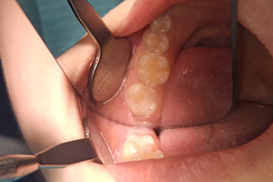 Пациент обратился с жалобой на эстетический дефект зуба 4.7