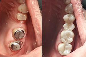 Пациент обратился с жалобами на отсутствие зуба 1.5 и разрушение зубов 1.6 1.7