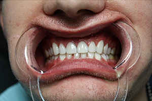 Пациент обратился с жалобами на эстетические дефекты зубов