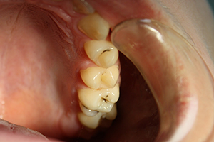 Пациент обратился с жалобами на появление кратковременных болевых ощущений при приеме холодной или горячей пищи в области 2.6 зуба