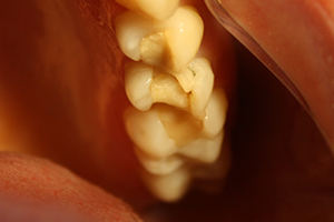 Пациент обратился с жалобами на разрушение пломб на зубах 2.4 2.5